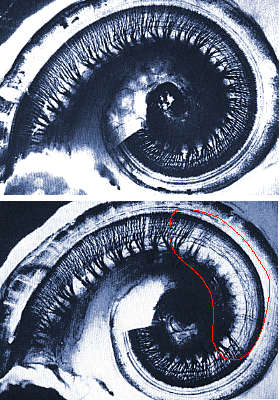 Zerstrung der Haarzellen im Innenohr durch Schalleinwirkung. Oben: Gesunde Cochlea, Unten: Geschdigte Cochlea mit Verlust der Haarzellen